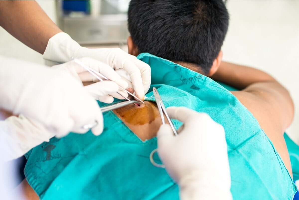 kirurgi för att ta bort godartade hudtumörer