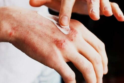 Person smörjer salva på hudutslag på handen.