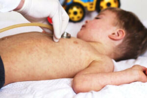 Staphylococcal scalded skin syndrome: Orsaker och symtom