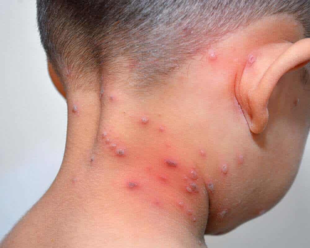scalded skin syndrome i nacken