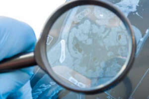 Vad är egentligen en gastrointestinal fistel?