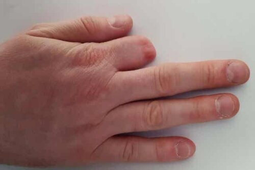 En hand med ett amputerat finger.