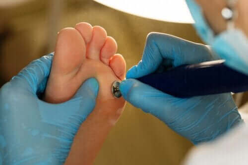 Medicinsk behandling för hudvalkar på händer och fötter