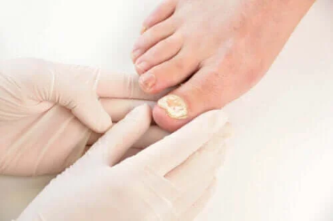 Sju sätt att förebygga nagelsvampinfektioner