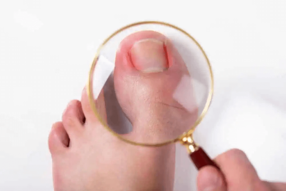förebygga nagelsvampinfektioner: förstoringsglas tittar närmare på stortå