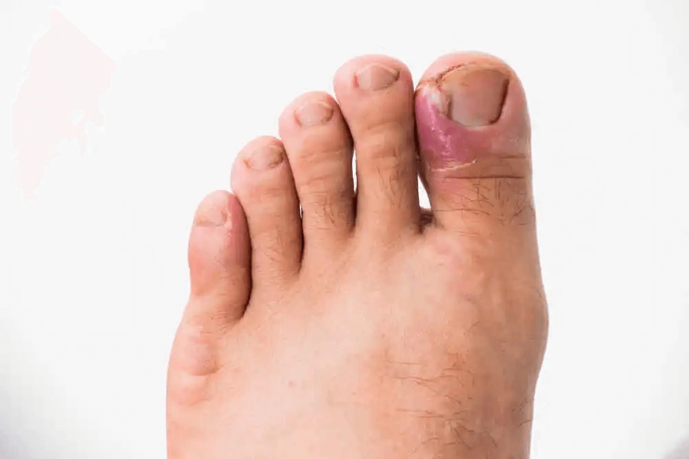 förebygga nagelsvampinfektioner: infekterad tånagel