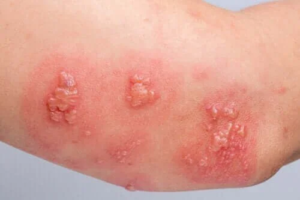Bullös pemfigoid: Orsaker, symptom och behandling