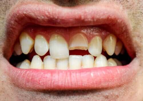 Skador på tänderna: Vad innebär det?