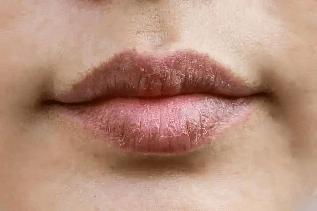 Användning av lanolinvax för nariga läppar