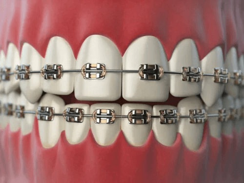 8 tips för personer som genomgår tandreglering