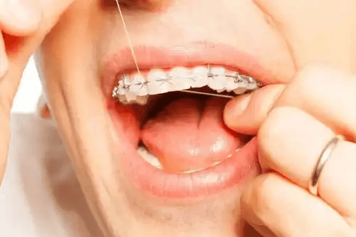 kvinna med tandställning använder tandtråd