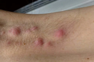 Kan din kost förbättra hidradenitis suppurativa?