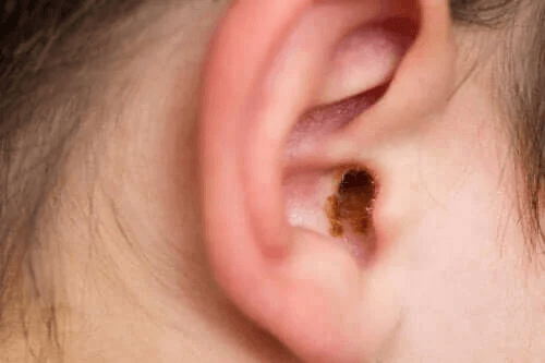 Symptom vid blockering på grund av öronvax