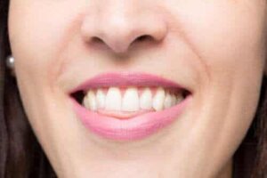 Vad är ett öppet bett och hur kan det åtgärdas?