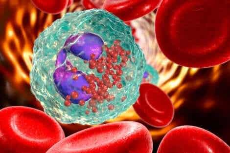 Medullär aplasi berör produktionen av röda och vita blodkroppar och av trombocyter