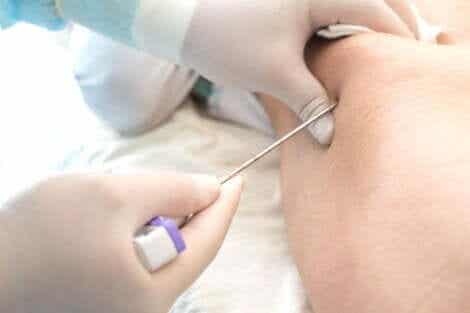 Ett benmärgsprov kan vara värdefullt vid diagnostiseringen av medullär aplasi