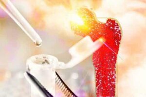 Lär dig om sjukdomen medullär aplasi