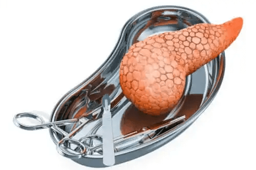 Transplantation av bukspottkörteln: När är det nödvändigt och vilka är riskerna?
