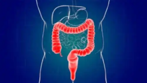 Inflammation i ändtarmen: Vad orsakar det och hur behandlar man det?