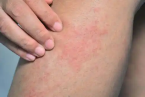 Cerkariedermatit eller badklåda: Orsaker, symptom och behandling