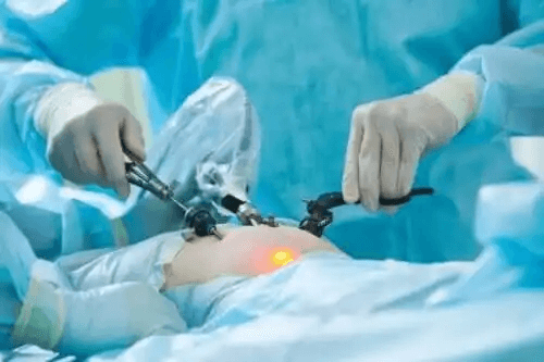 Vad innebär en laparoskopisk kirurgi?