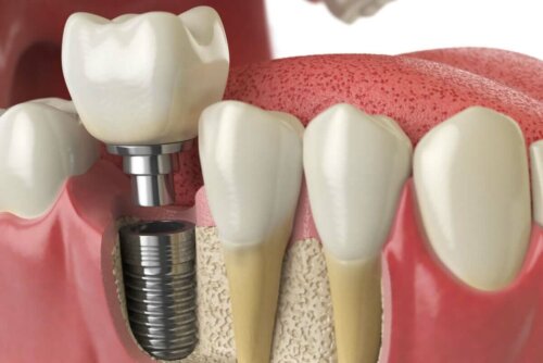 Dentala implantat och proteser