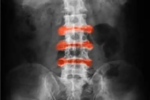 Världsdagen för ankyloserande spondylit