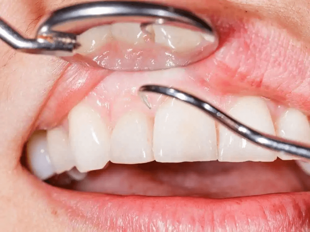 Plack på tänderna går inte alltid att se med blotta ögat. 
