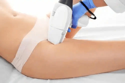 bikinizon blir behandlad med intensivt pulserande ljus