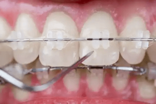 tänder med tandställning