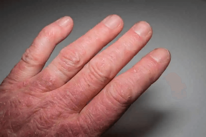hand med lupus