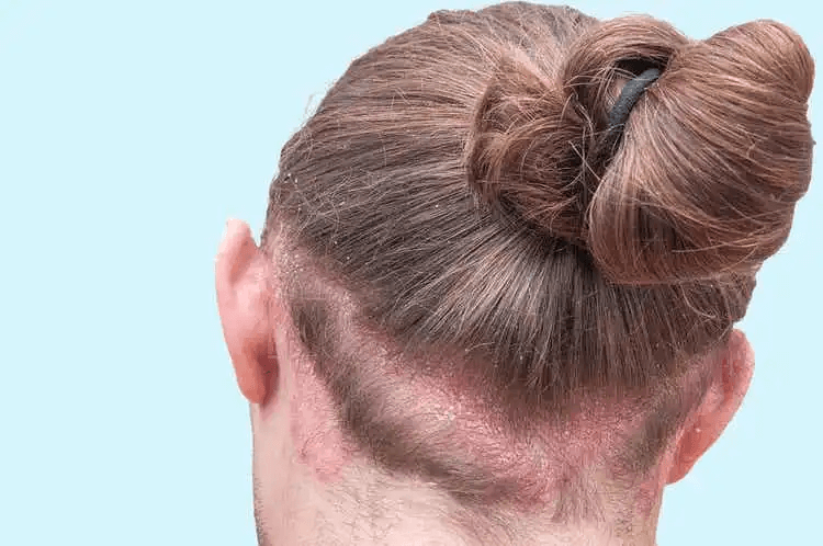 person med allvarligt fall av mjäll i hårbottnen