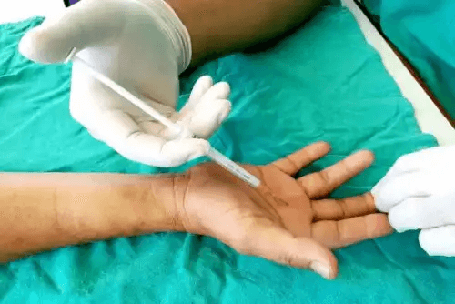 subkutan injektion i hand
