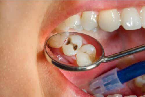 Håligheter i närbild av en mun och tandspegel