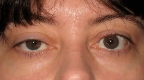 Ptos eller hängande ögonlock: Orsaker och behandlingar