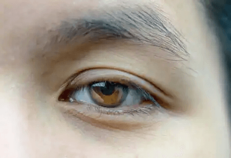 brunt öga