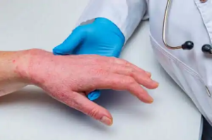 Psoriasis och kranskärlssjukdom: Hur är de relaterade?