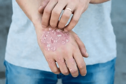 psoriasis och kranskärlssjukdom