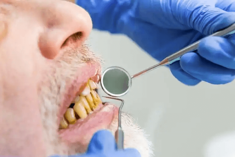 man med dåliga tänder hos tandläkare