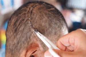 Vad är en kraniotomi och när är det nödvändigt?