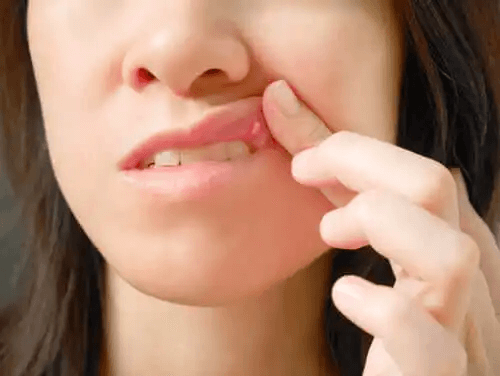 Orsaker till munsår och möjliga behandlingar