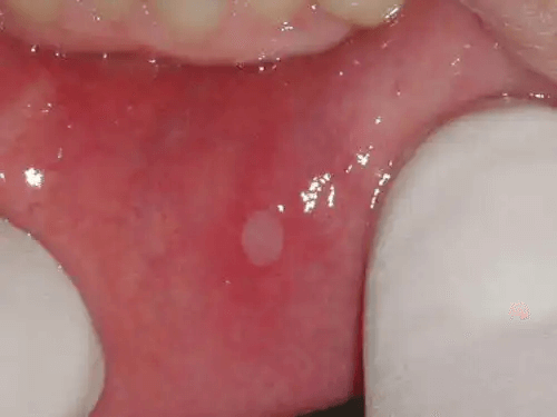 Munsår på tandköttet