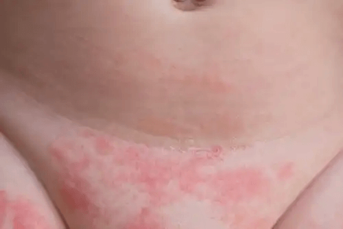 person med dermatit på