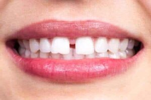 Vad är diastema mediale? Kännetecken och orsaker