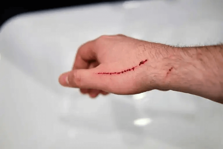 mans arm med ett skärsår på handen