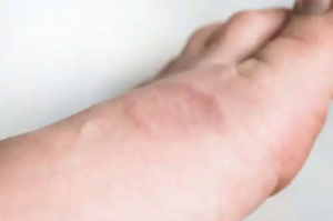 Symptomen och behandlingen av granuloma annulare