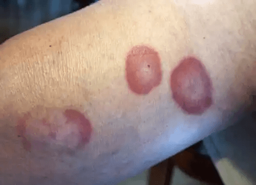 Röda cirkulära skador på en persons arm.