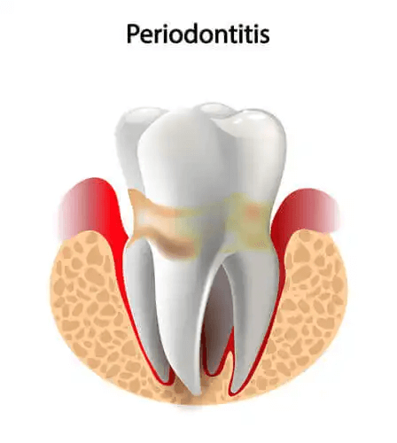 En tand med parodontit.