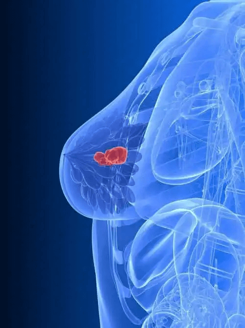 Bröstcancerdiagram behandlat med hormonbehandling