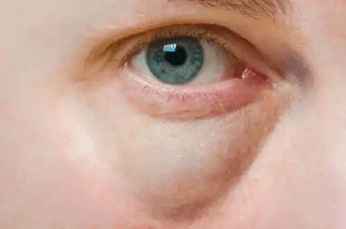 Har du svullna ögonlock? Orsaker och behandling